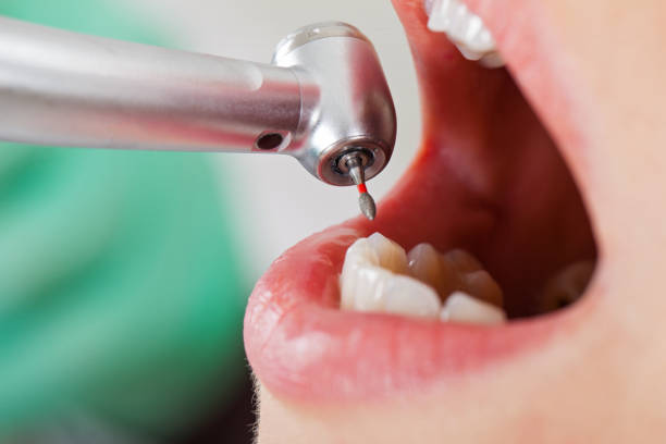Best Emergency Dental Care for Abscessed Tooth in West Springfield, VA
